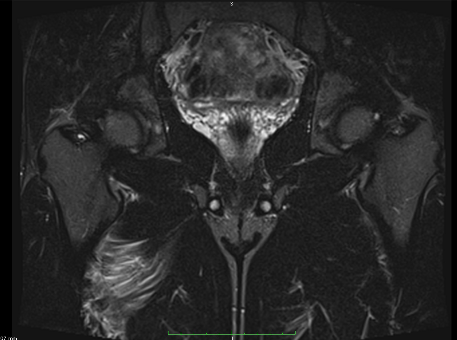 Adductor magnus injury therapy MRI