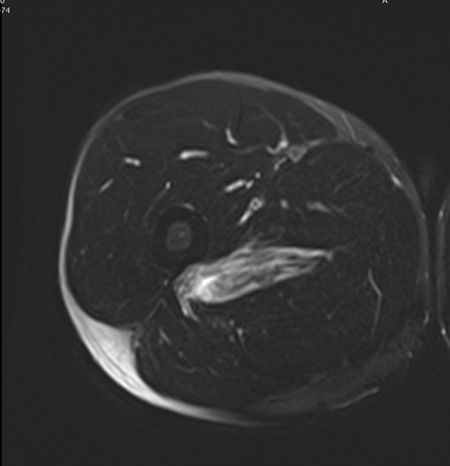 Adductor magnus injury therapy