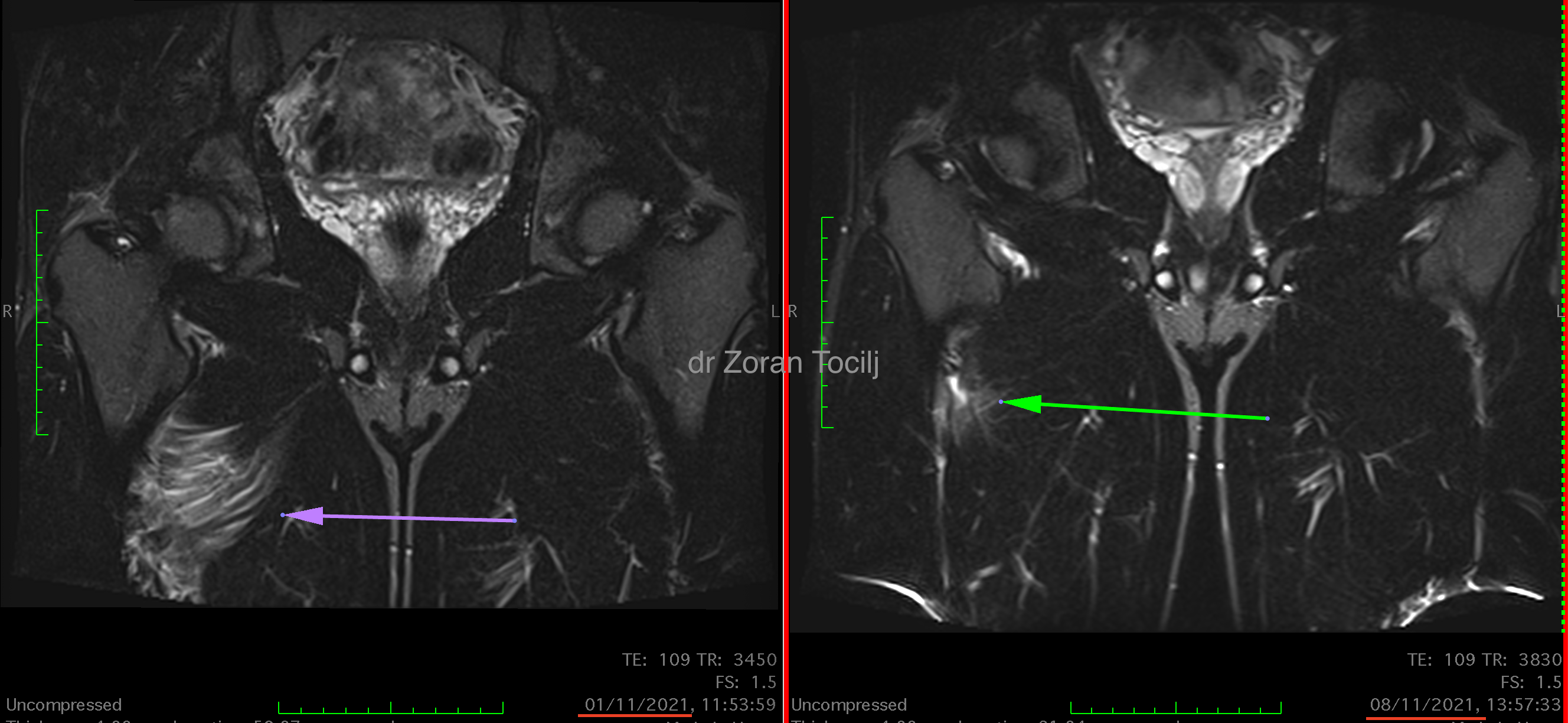 Adductor therapy before and after