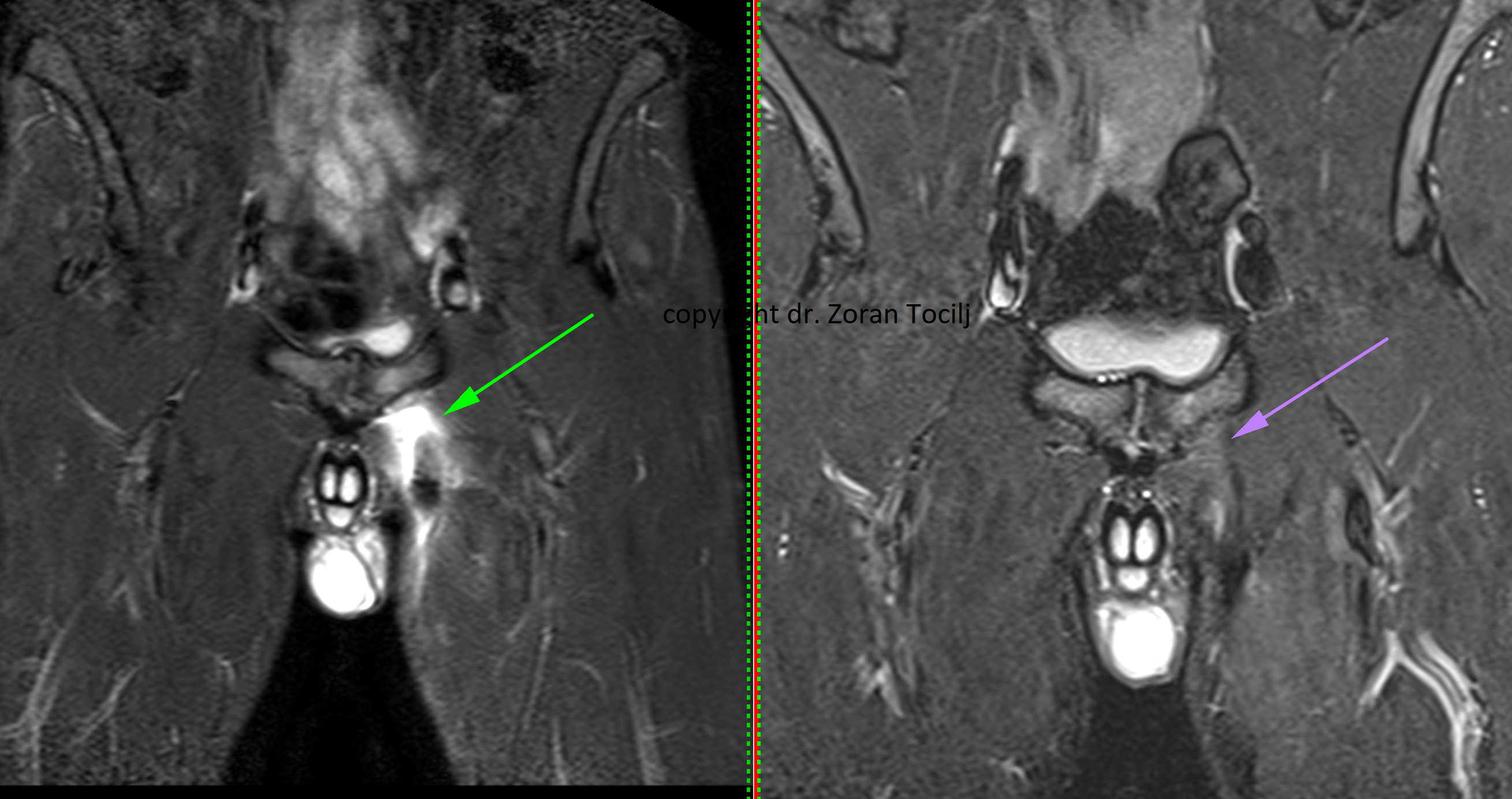Avulsion tendon injury