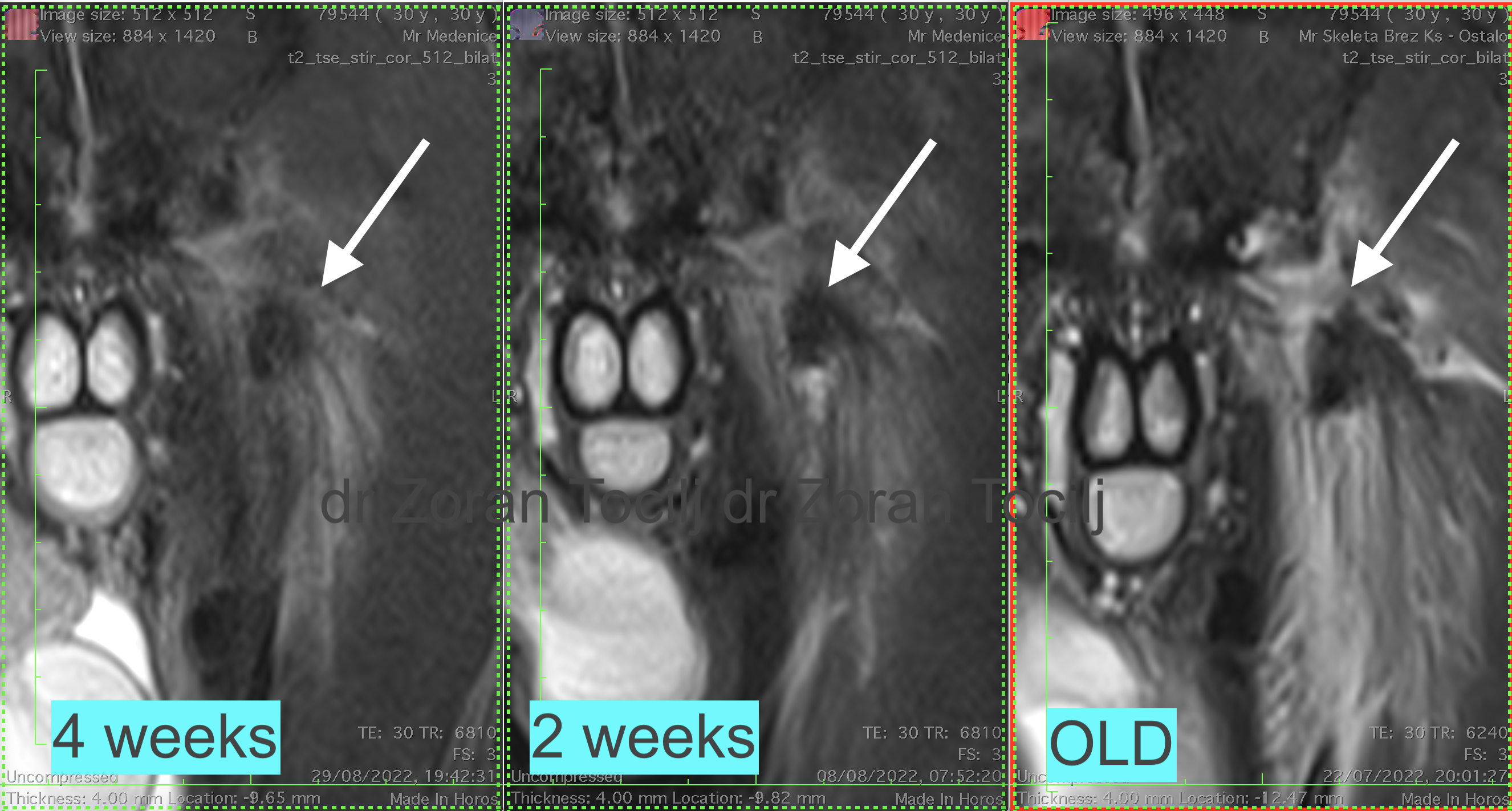 Adductor longus 4 weeks therapy