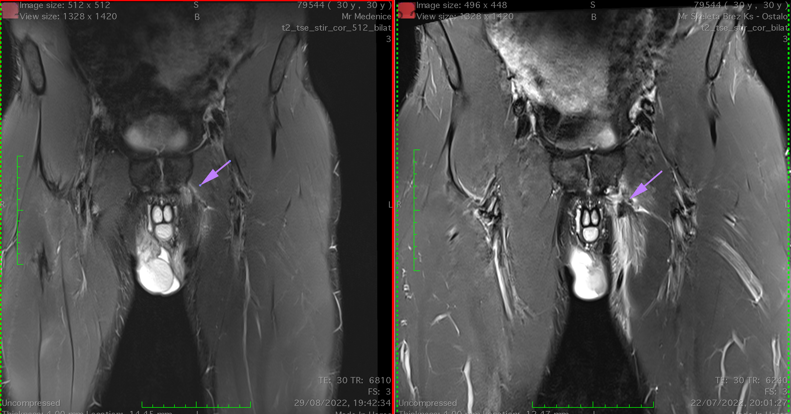 Adductor longus healed