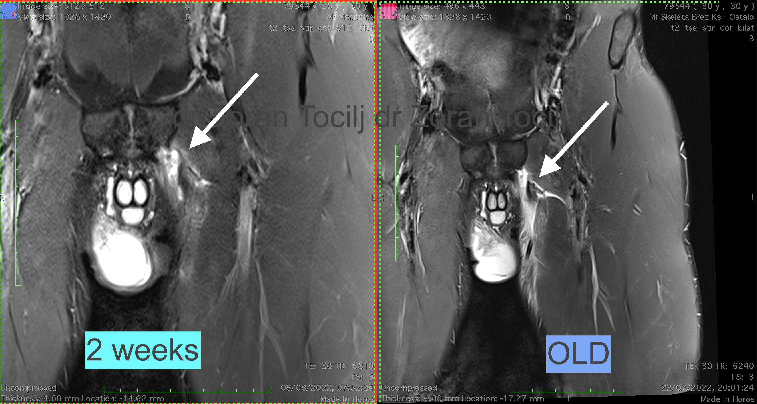 Adductor longus therapy 2 weeks