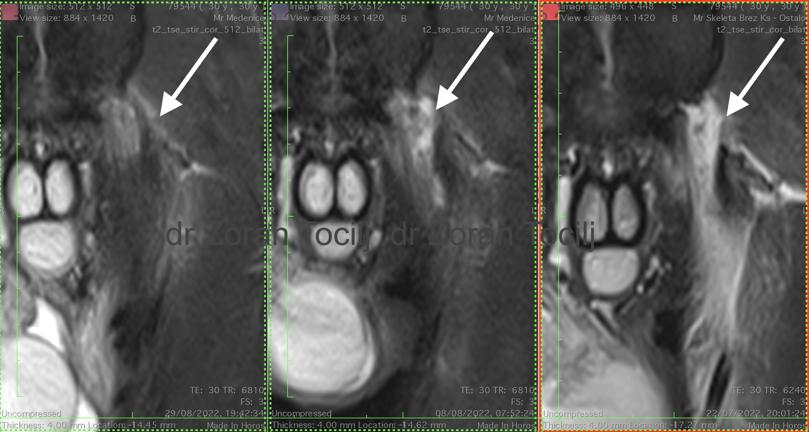 Adductor longus 4 weeks therapy