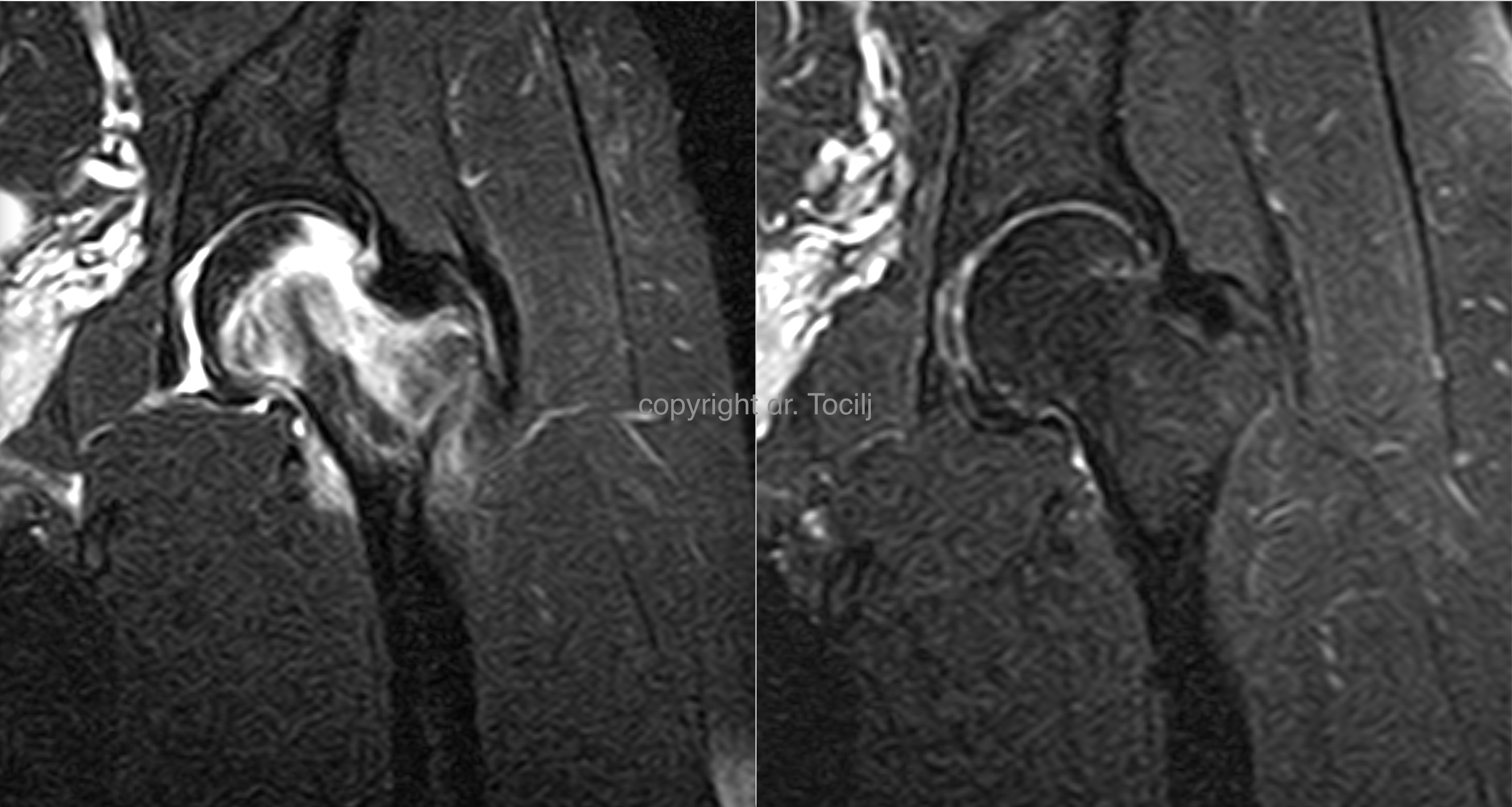 Hip bone edema treatment