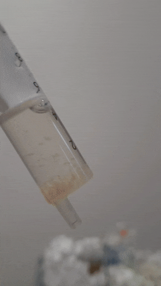 ElbowAspirationCartilager Interesting elbow joint aspiration (arthrocentesis)