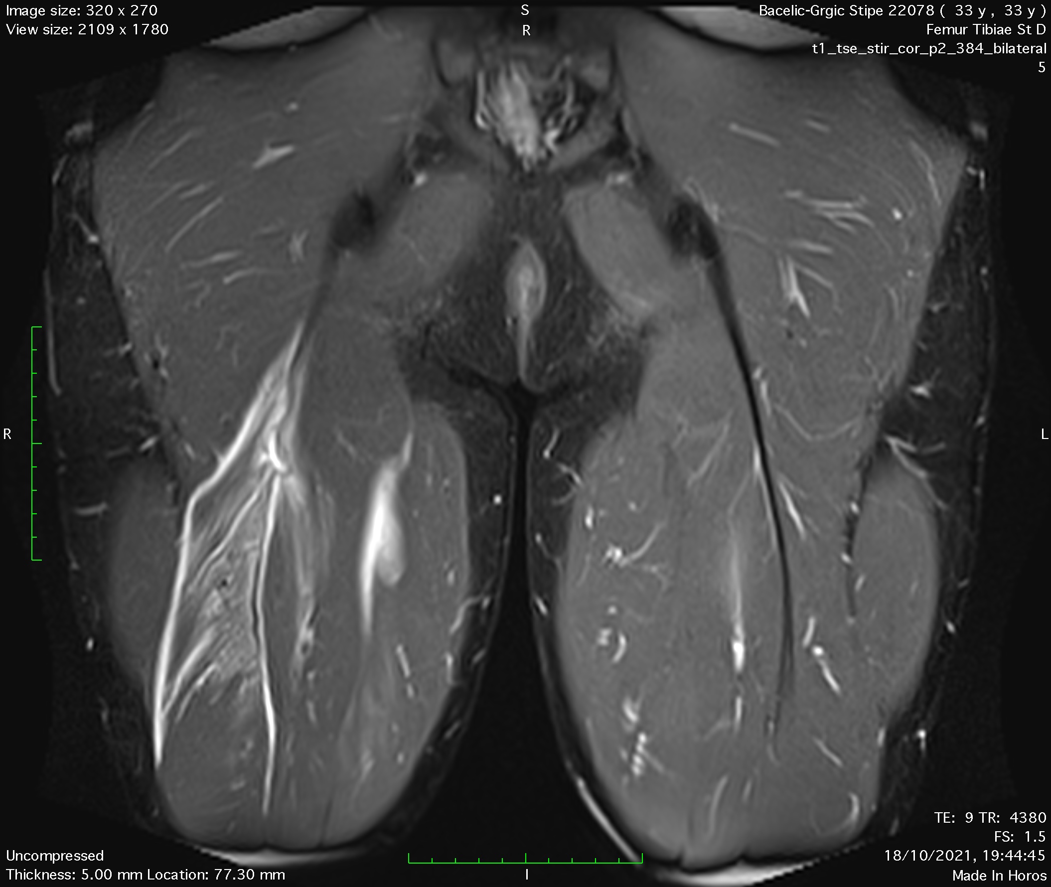 Hamstring biceps tendon injury MRI