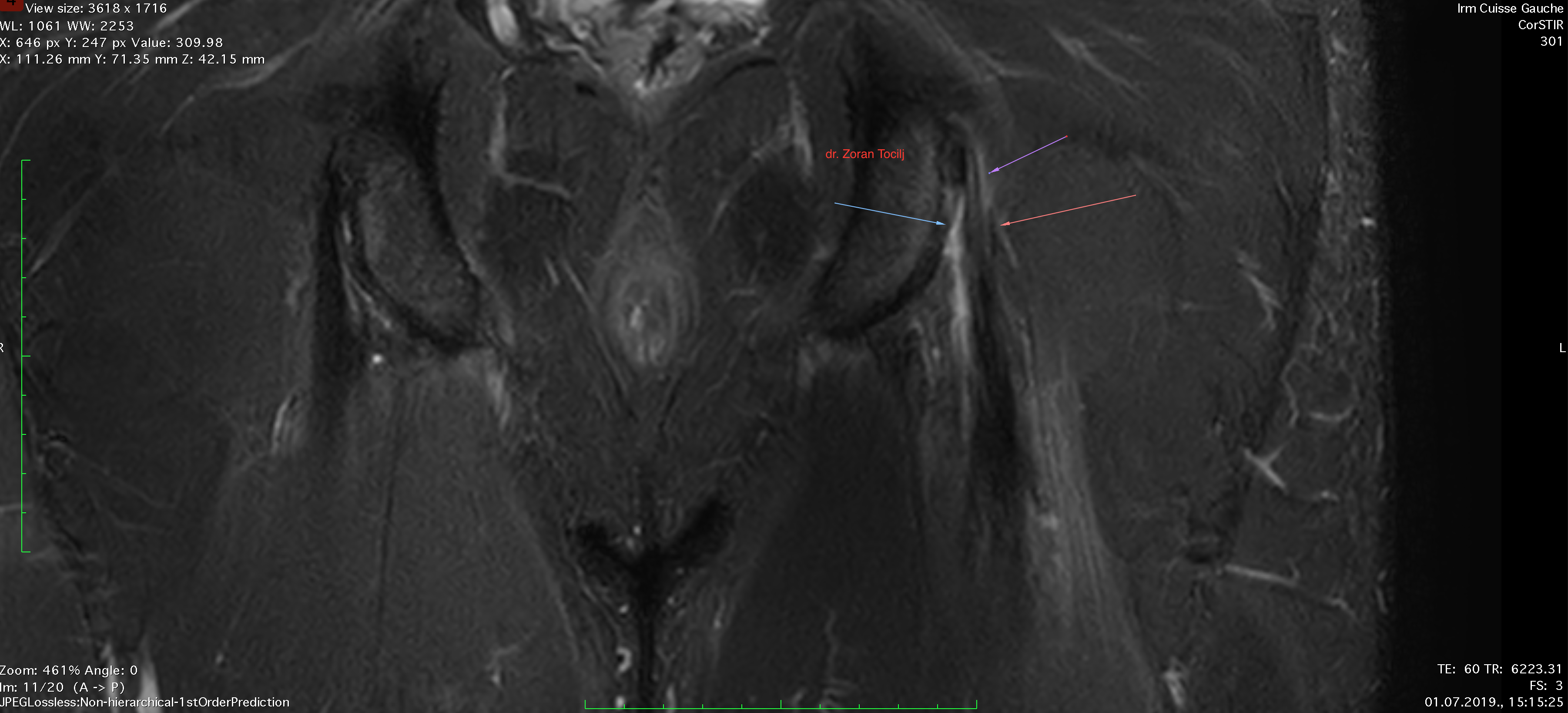 Hamstring Proximal Tendon Rupture Therapy