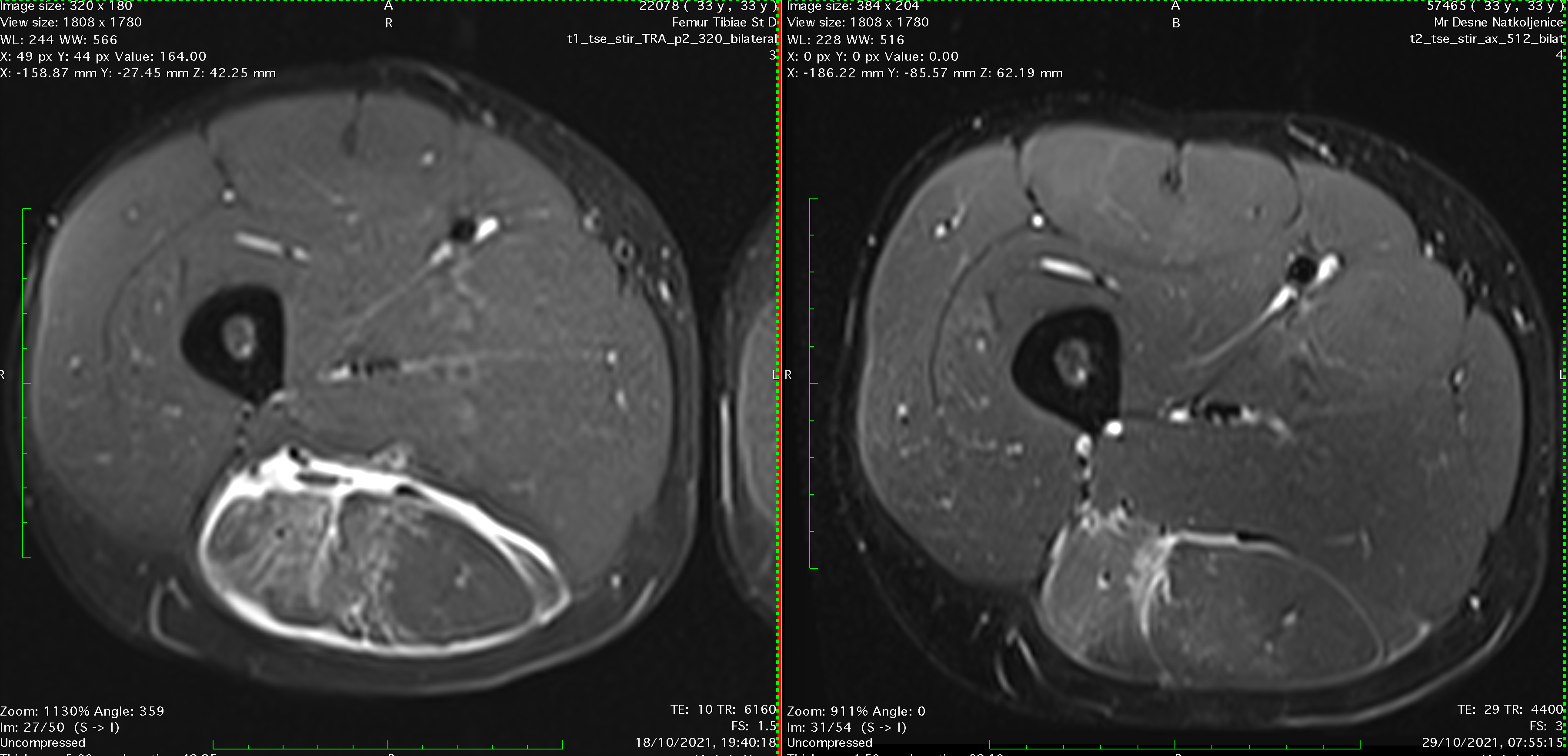 hamstring intramuscular biceps tendon injury therapy