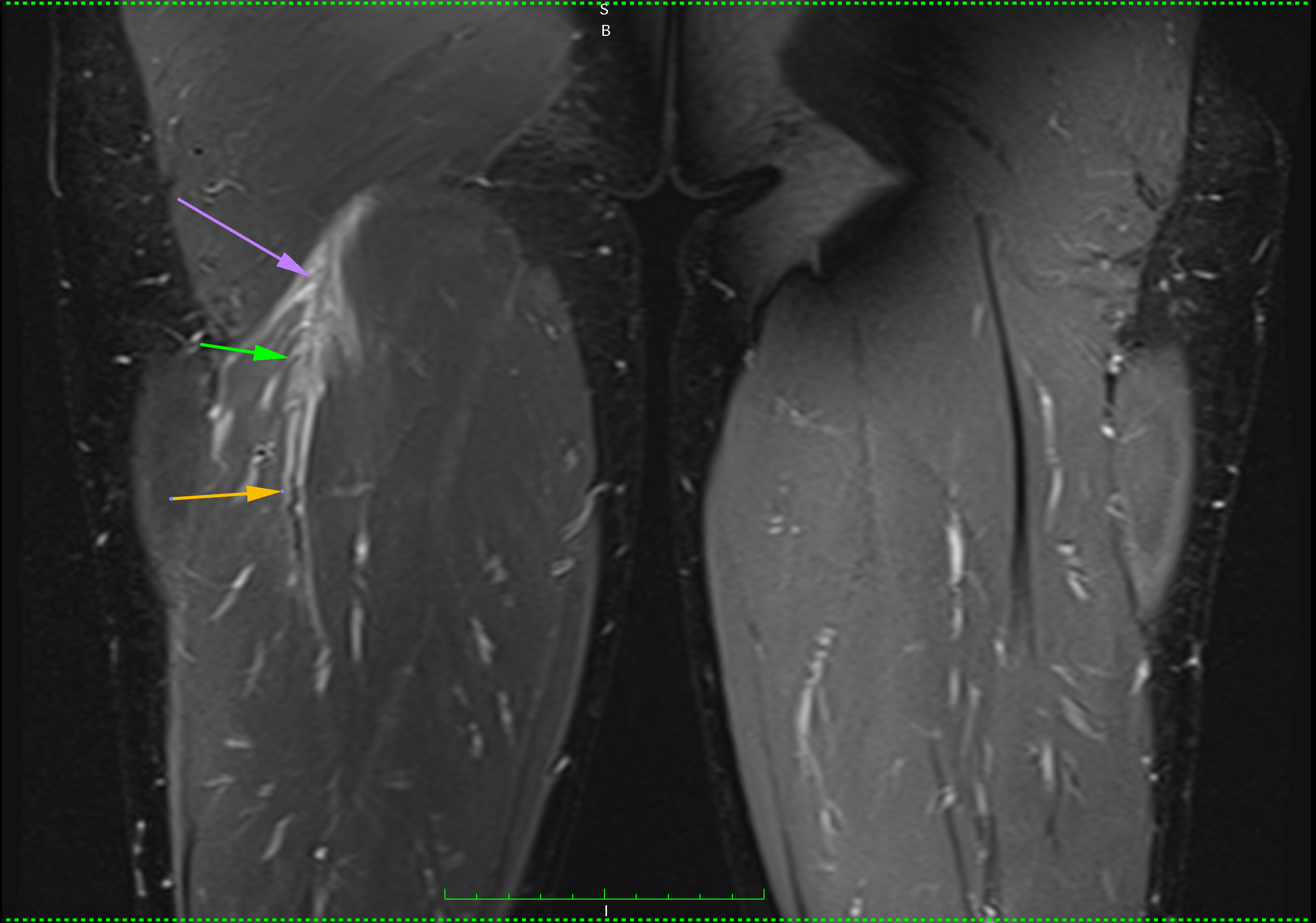 hamstring intramuscular biceps tendon injury