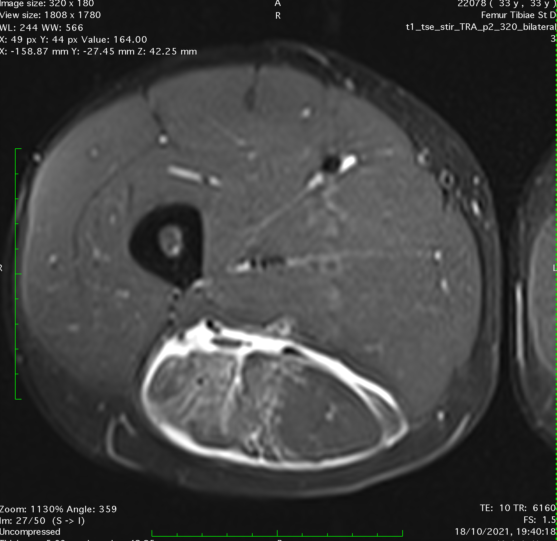 Hamstring biceps tendon injury