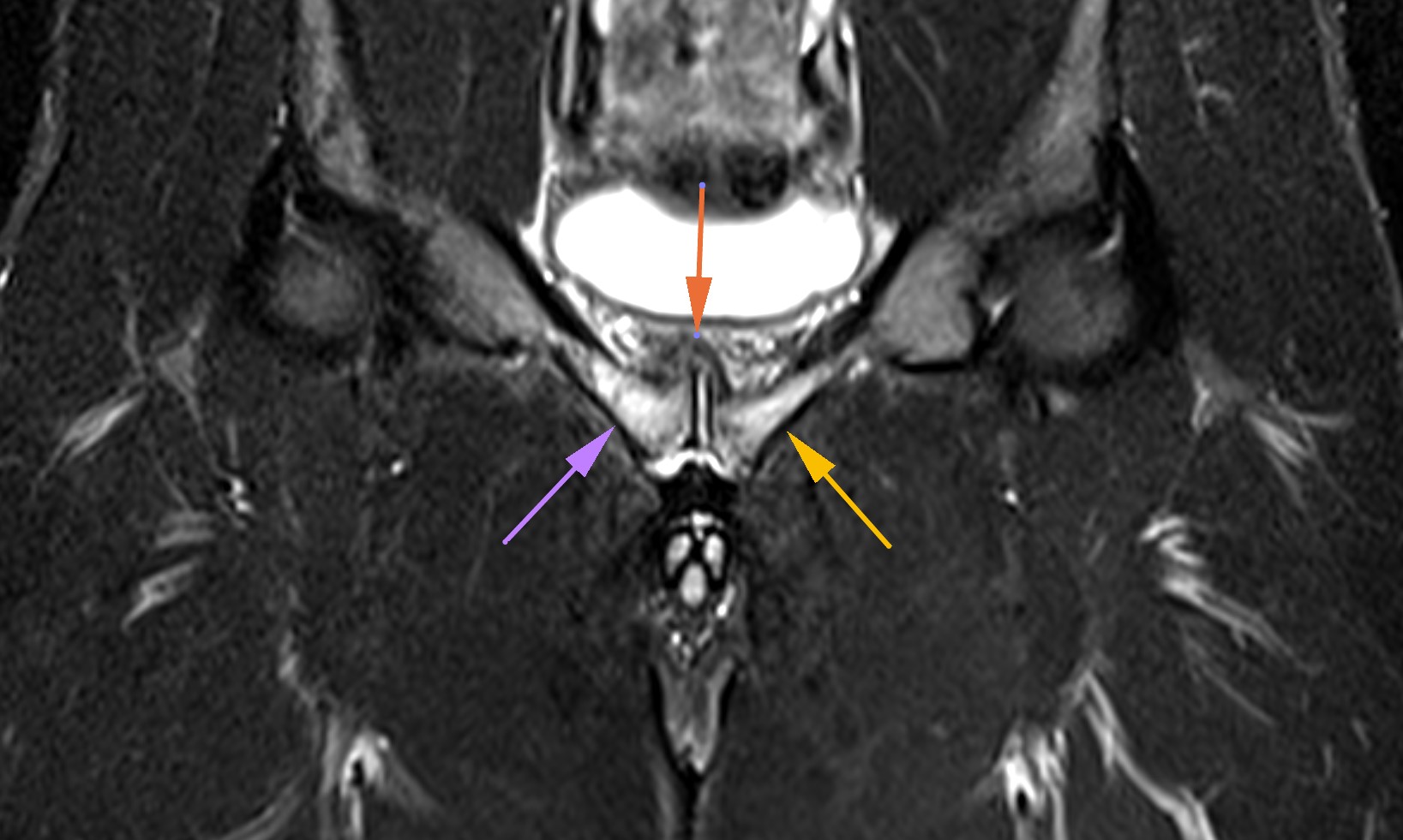 Pubic bone inflammation