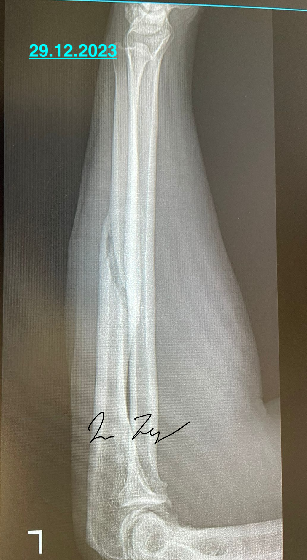 Fracture ulna healed