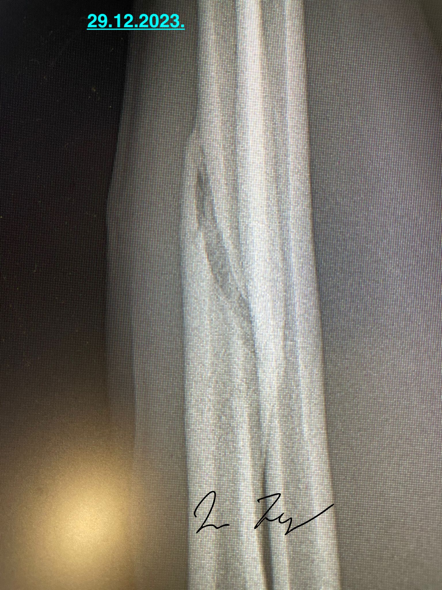 Complete fracture healing