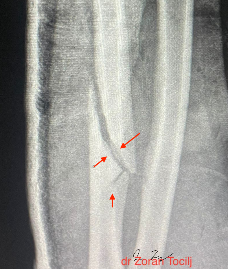 Fracture initial healing