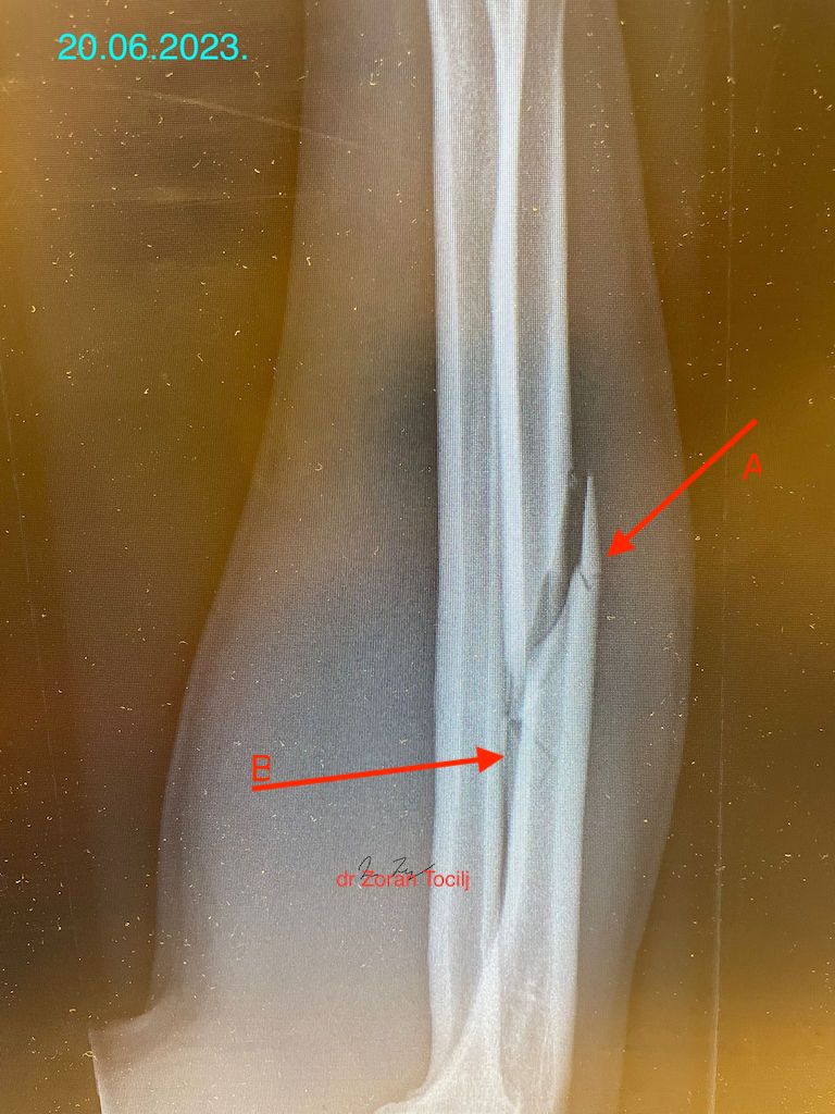 Ulna fracture before repositioning comment
