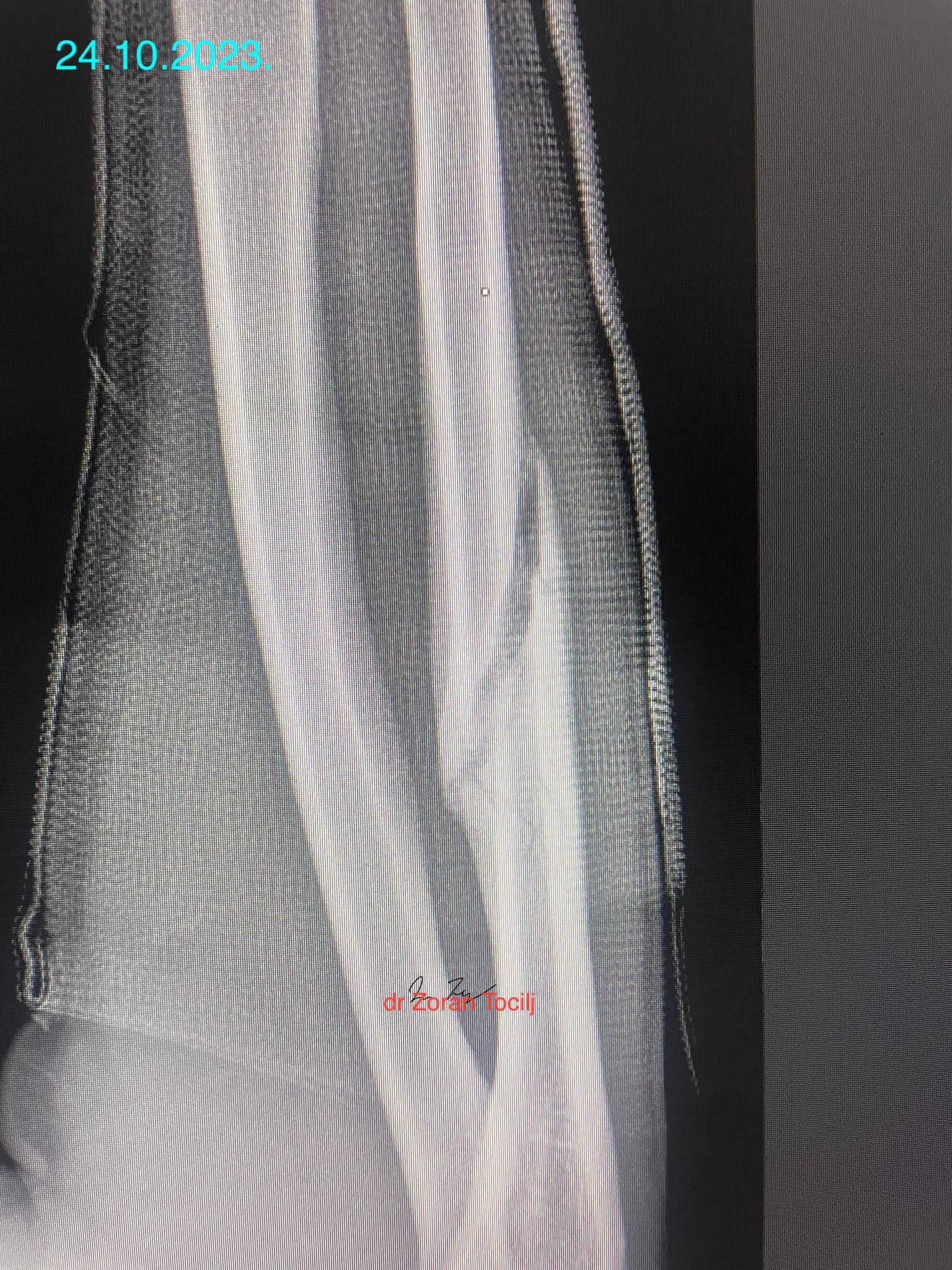Fracture closing 19 weeks