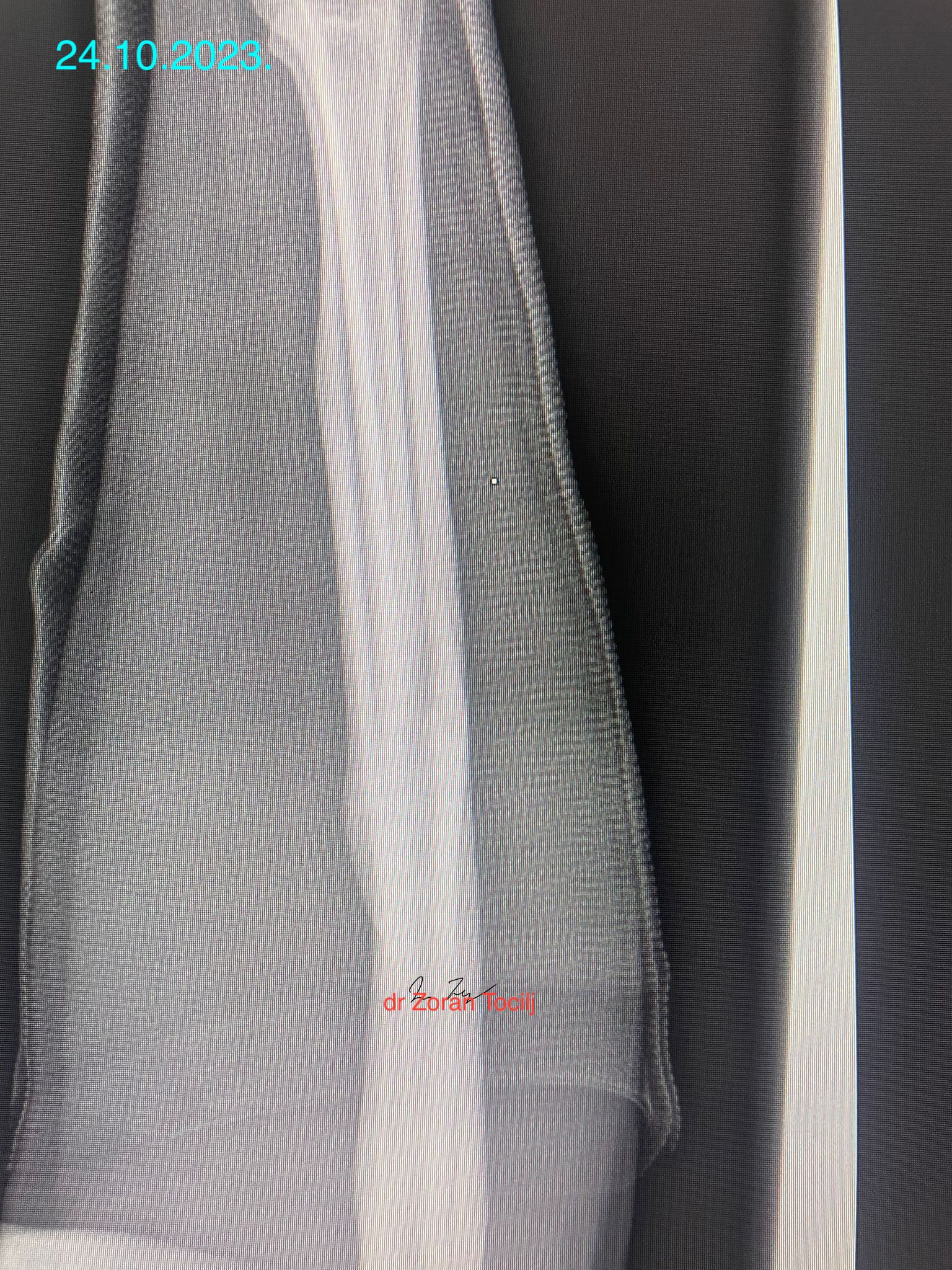 Fracture closing 19 weeks