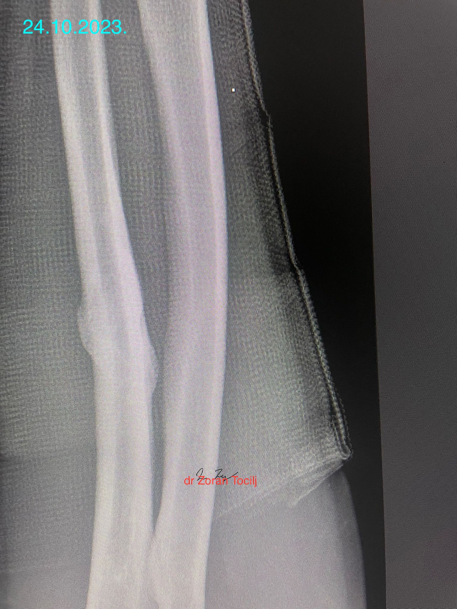 Fracture almost closed