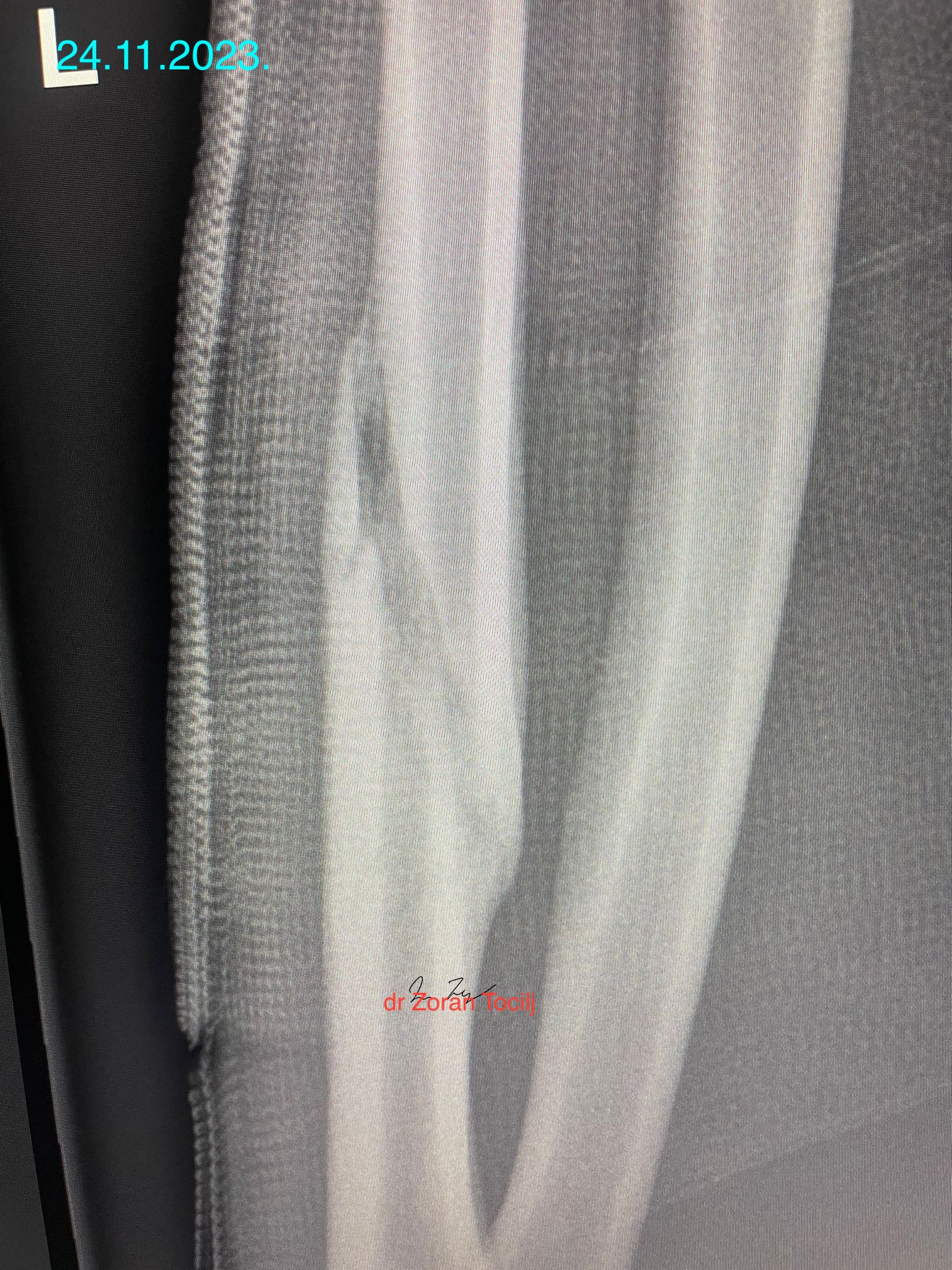 Almost closed ulna fracture