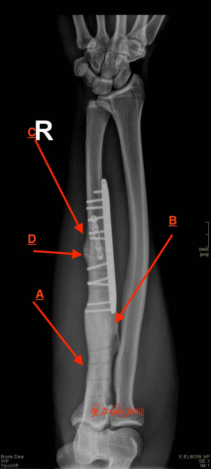 Fracture operation ulne complications
