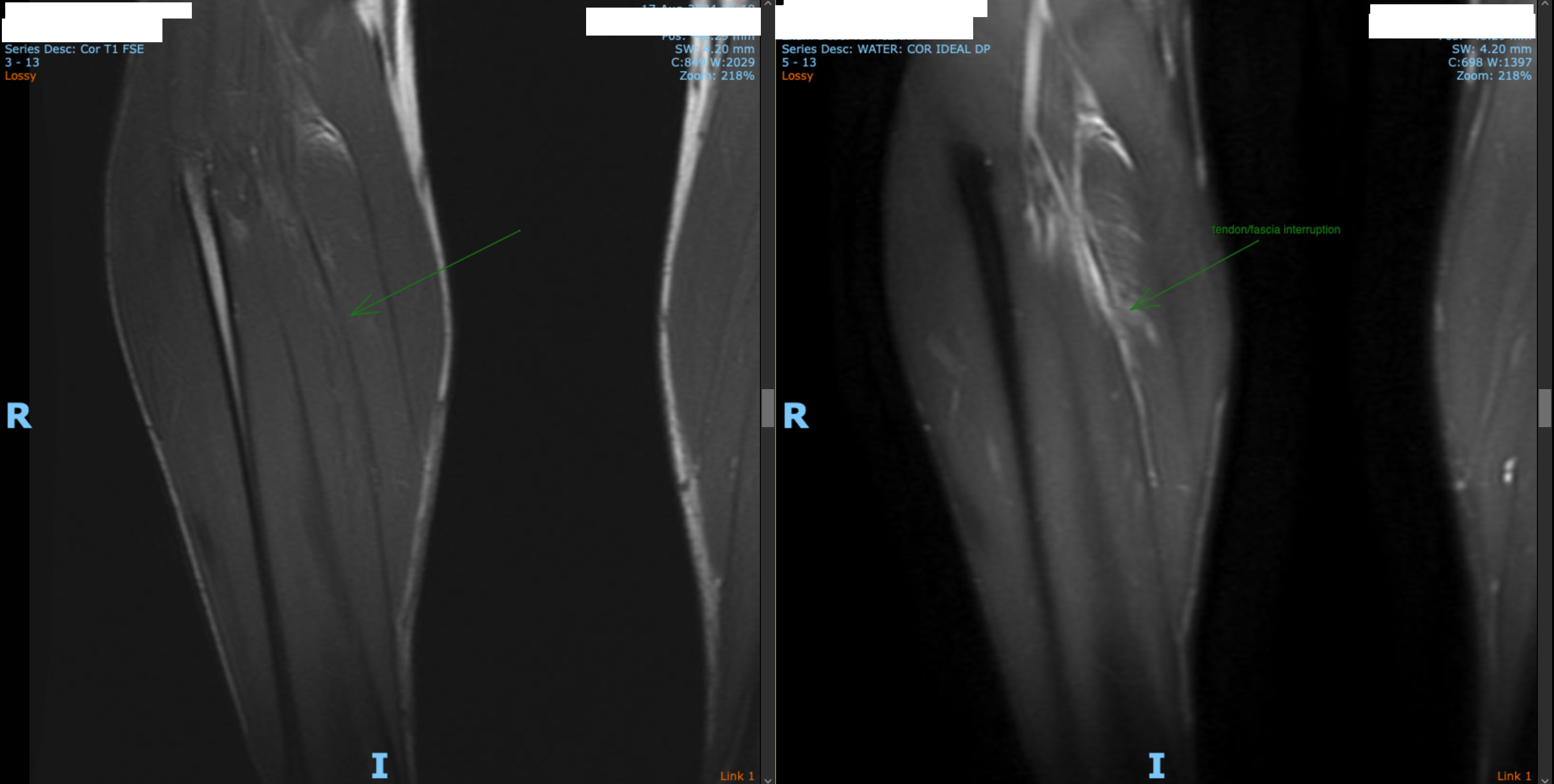 Unrecognised intramuscular injury