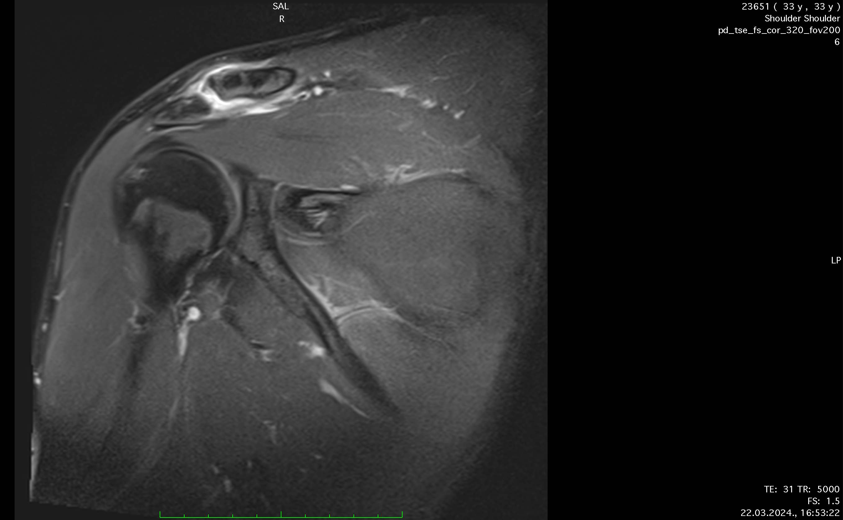 SHOULDER_POST_CORpic