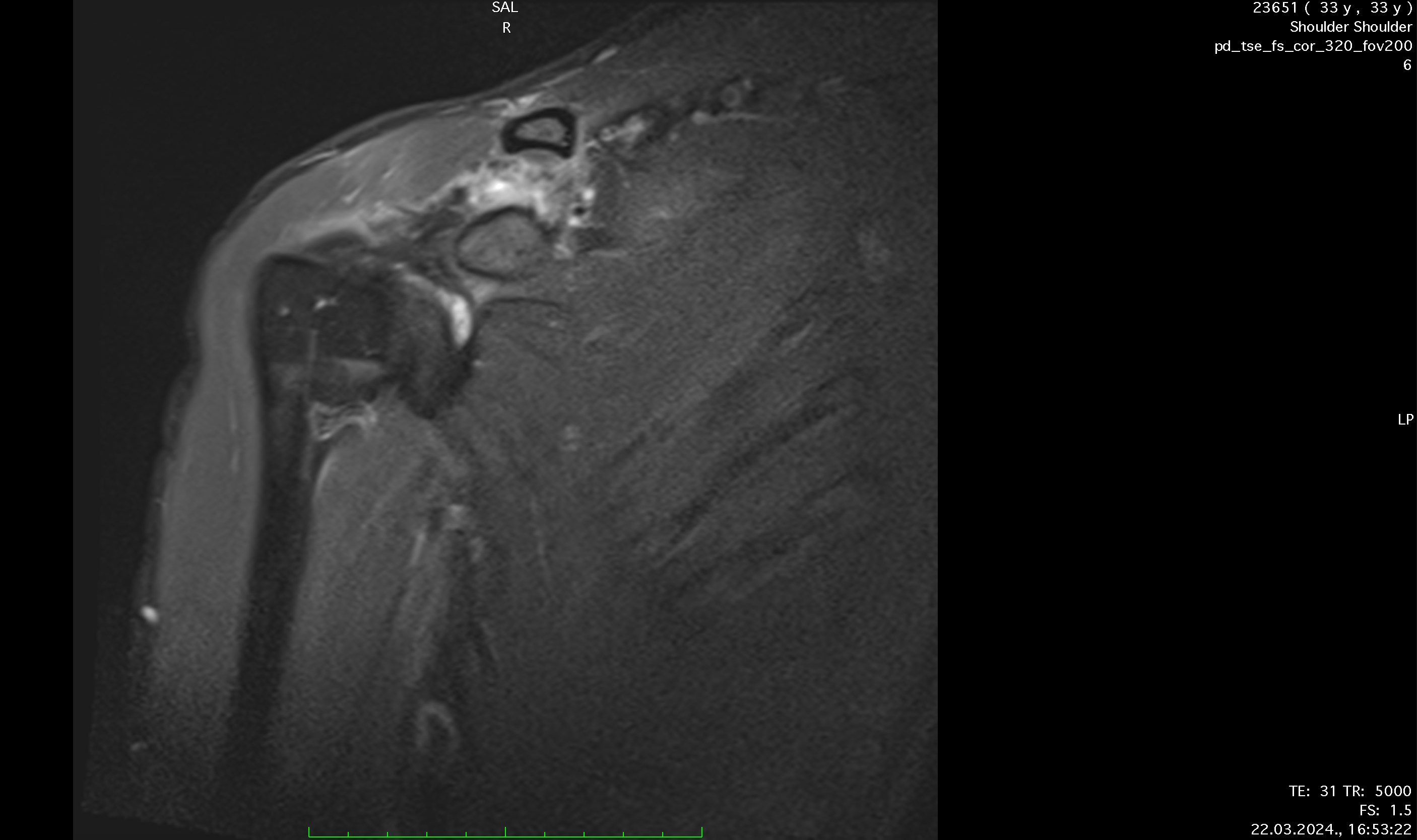 SHOULDER_POST_CORpic2