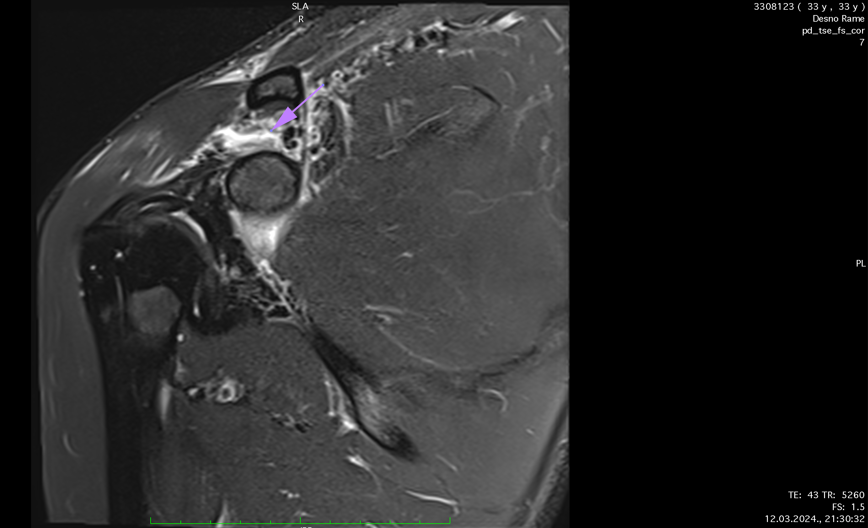 SHOULDER_PRE_CORpic2