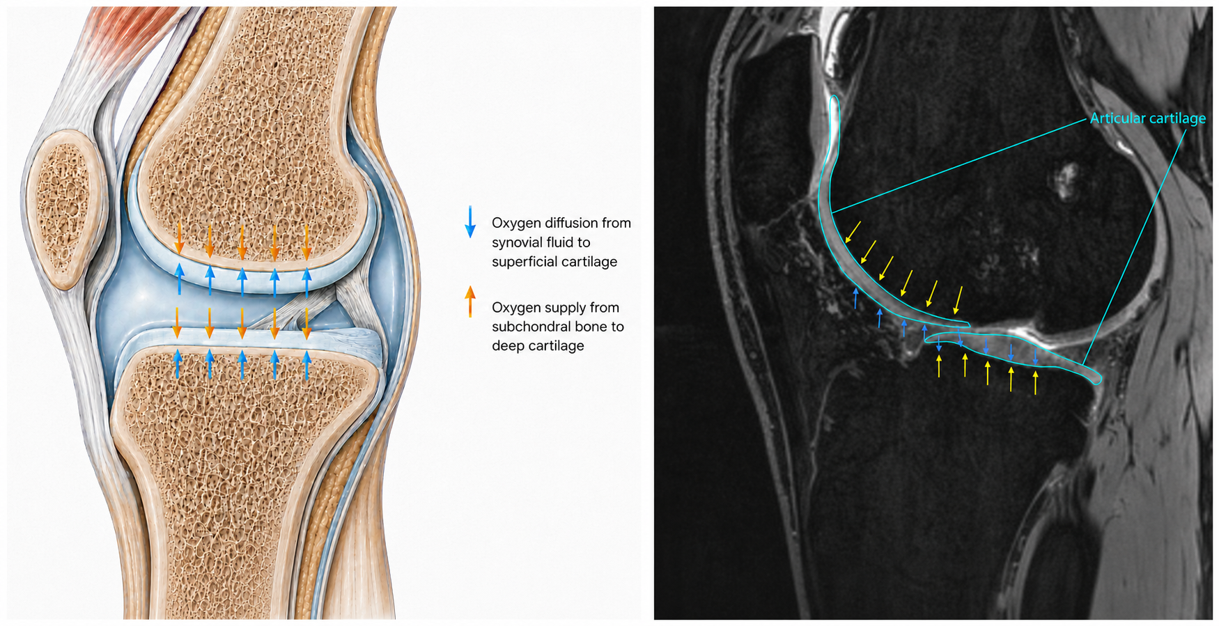 Anatomical illustration and sagittal knee MRI showing oxygen diffusion to articular cartilage from synovial fluid and subchondral bone