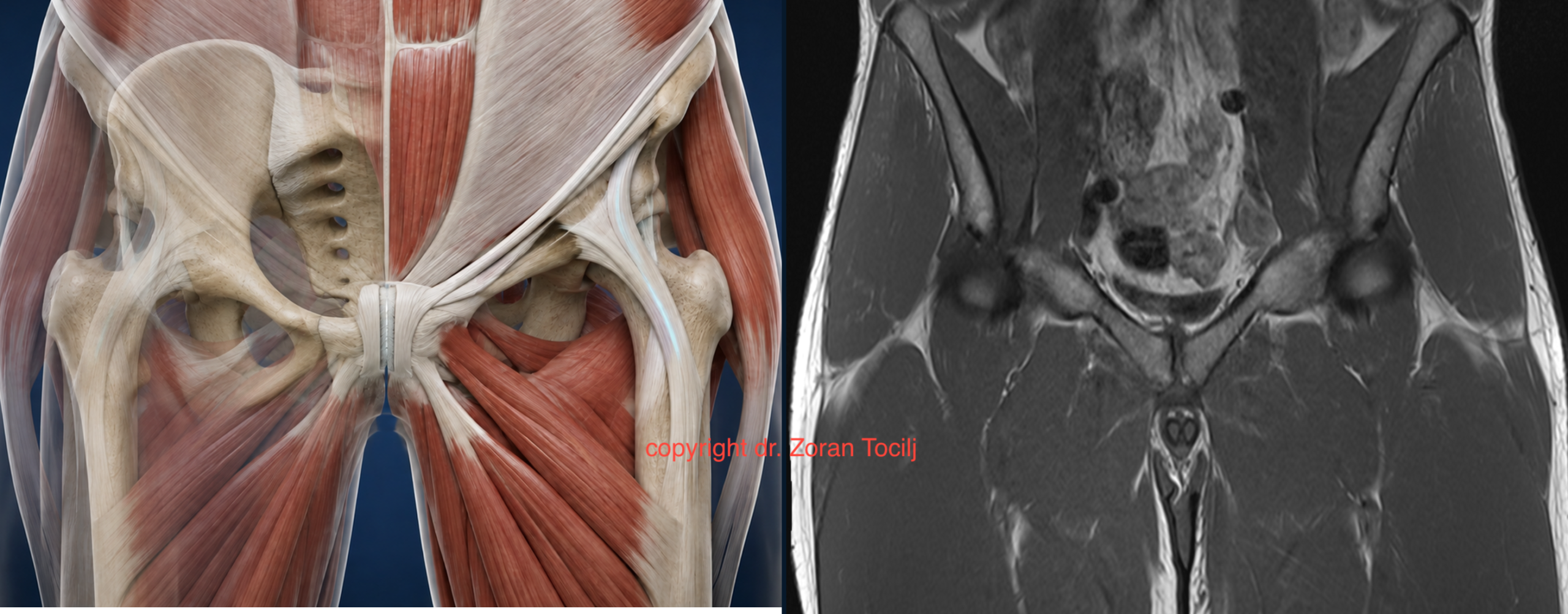 Pubic bone and pubic symphysis anatomy shown beside an MRI image