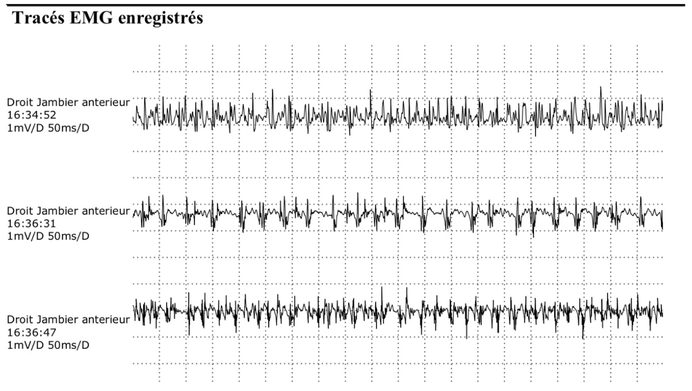 January 2022: tibialis anterior EMG recordings. The original calibration is retained in both excerpts: 1 mV/division and 50 ms/division. The examiner described improved motor-unit size and renewed motor activity compared with November 2021.