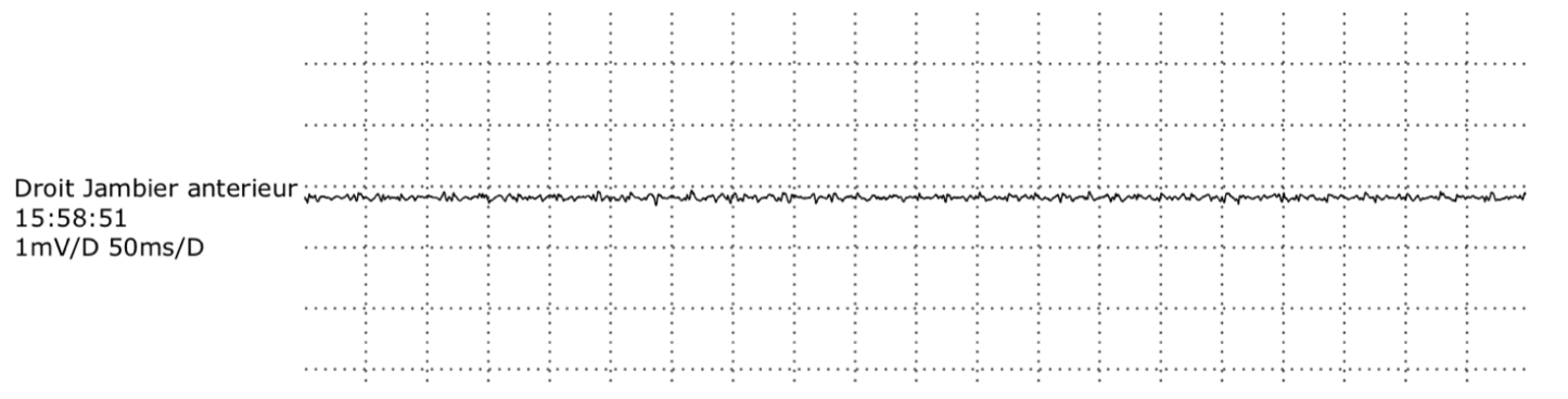 1 November 2021: comparison tibialis anterior EMG tracing. The treating physician confirmed that “2022” in the original comparison heading was a typographical error; the waveform itself is unchanged.